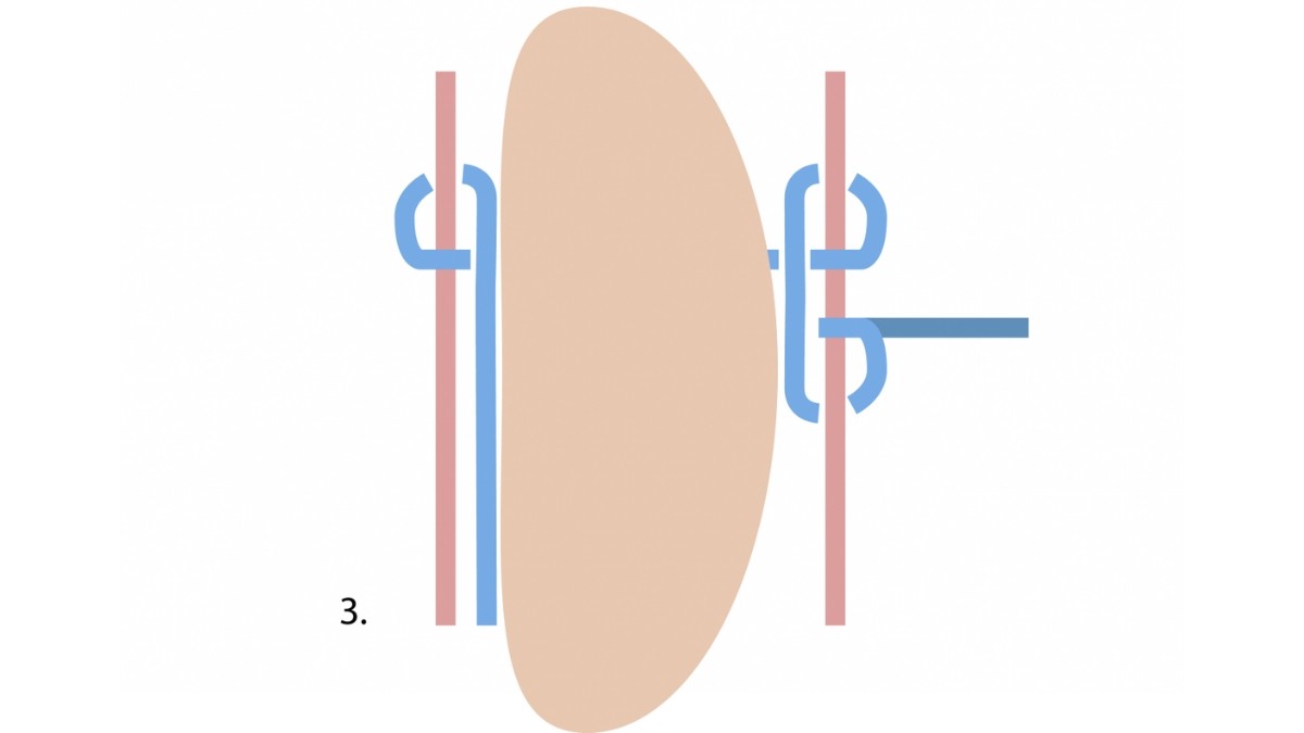 Come crimpare una pietra macramè? : Tappa 3